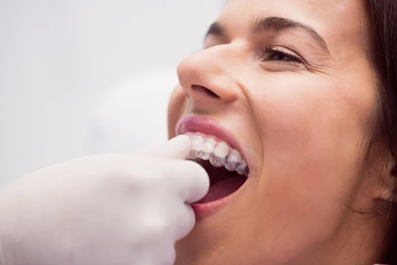 Quanto custa o invisalign